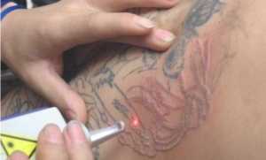 como remover tatuagem naturalmente