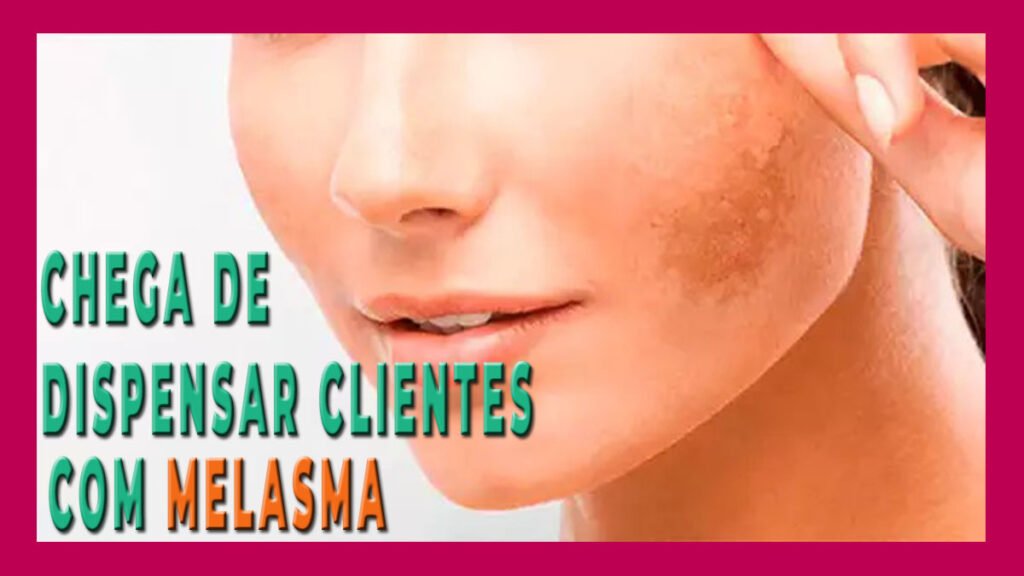 Chega de Dispensar C1ientes com MELASMA por Medo de Não Obter os Resultados Desejados 1